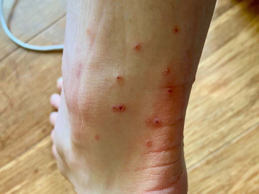 Chigger bites on ankle